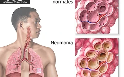 Neumonía: Consecuencias, Prevención y Medicina Alternativa