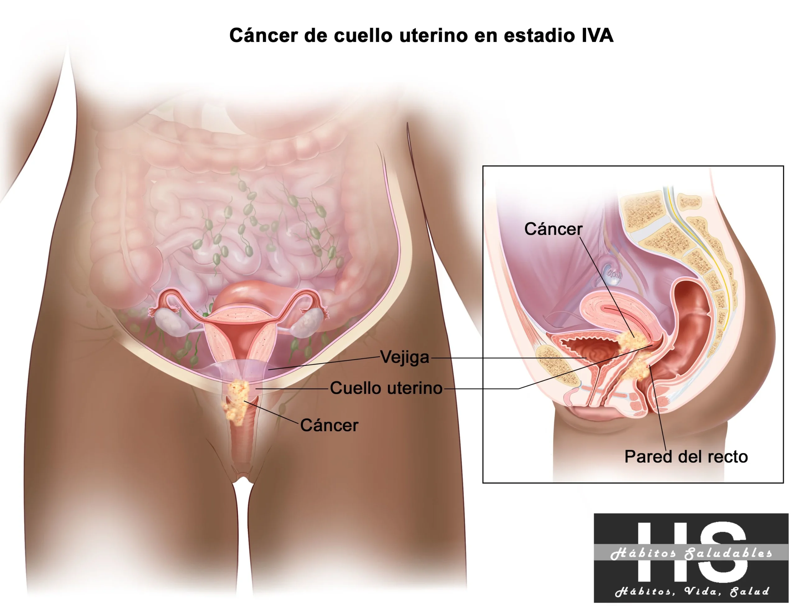 cáncer de cuello uterino en estadio IVA