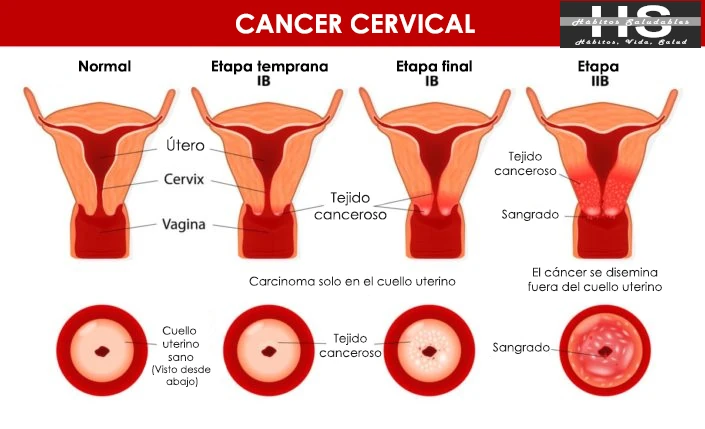 cáncer cervicouterino