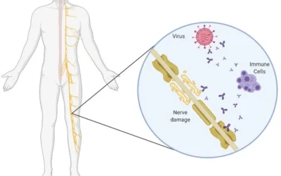 Descubriendo el Guillain-Barré: Una mirada a esta enfermedad autoinmune