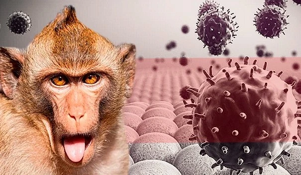 Viruela del Mono: Síntomas, Causas y Medicina Alternativa